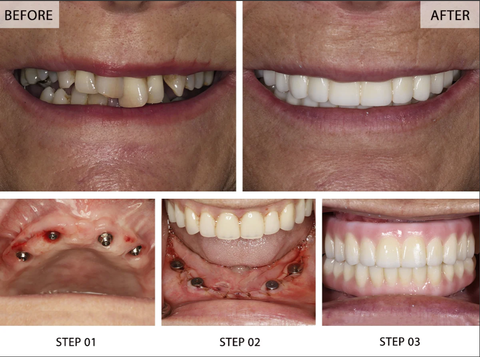 Dental Implants