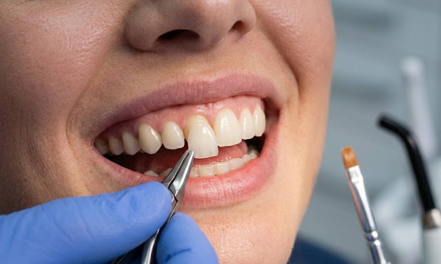 Veneers in Turkey